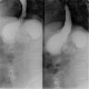 Gastric banding, slipped: RF - Fluoroscopy
